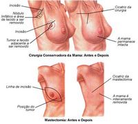 MASTECTOMIA